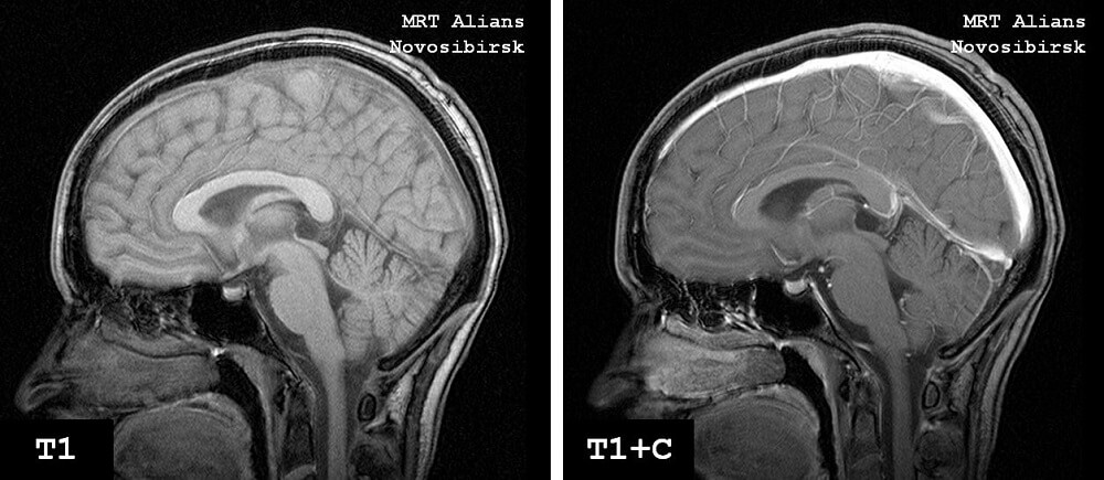 МРТ головного мозга до и после контрастного усиления