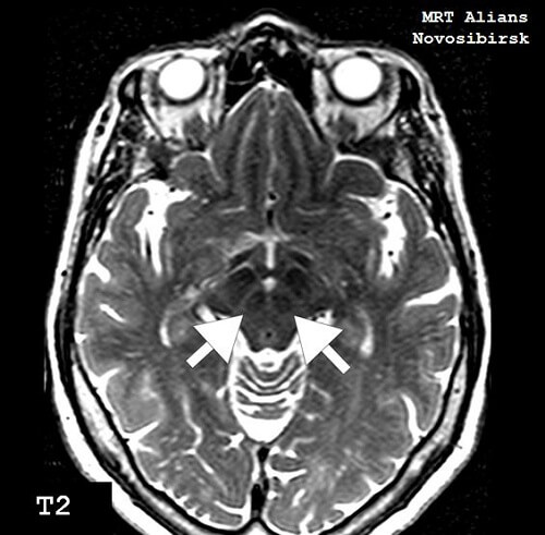 МРТ головного мозга для исключения болезни Паркинсона