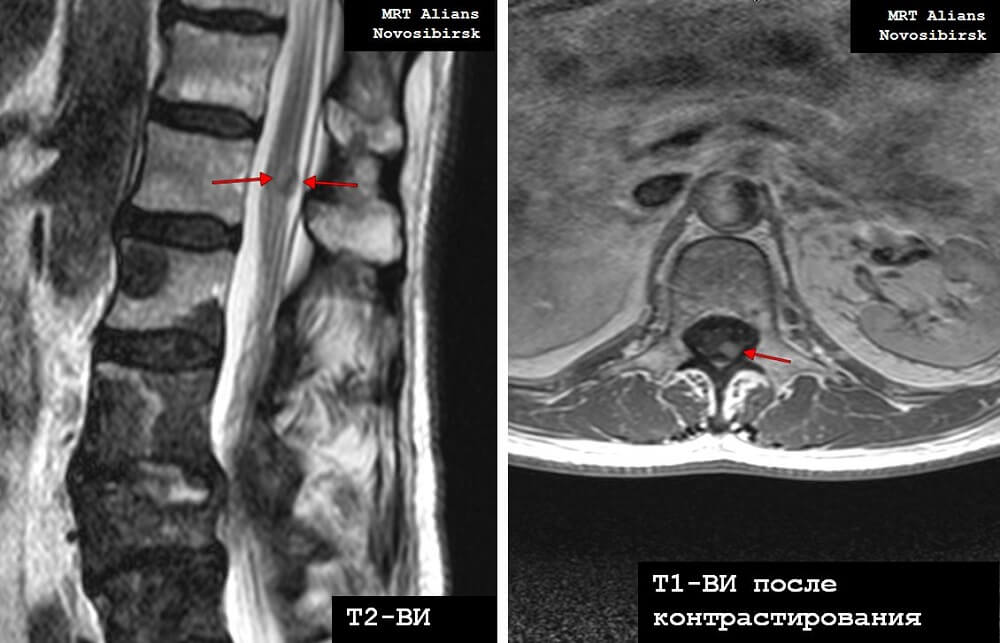 Очаг метастатического поражения спинного мозга в пояснично-крестцовом отделе