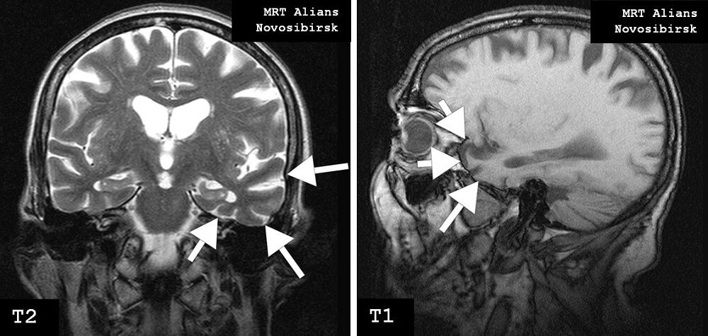 МРТ головного мозга для исключения болезни Альцгеймера